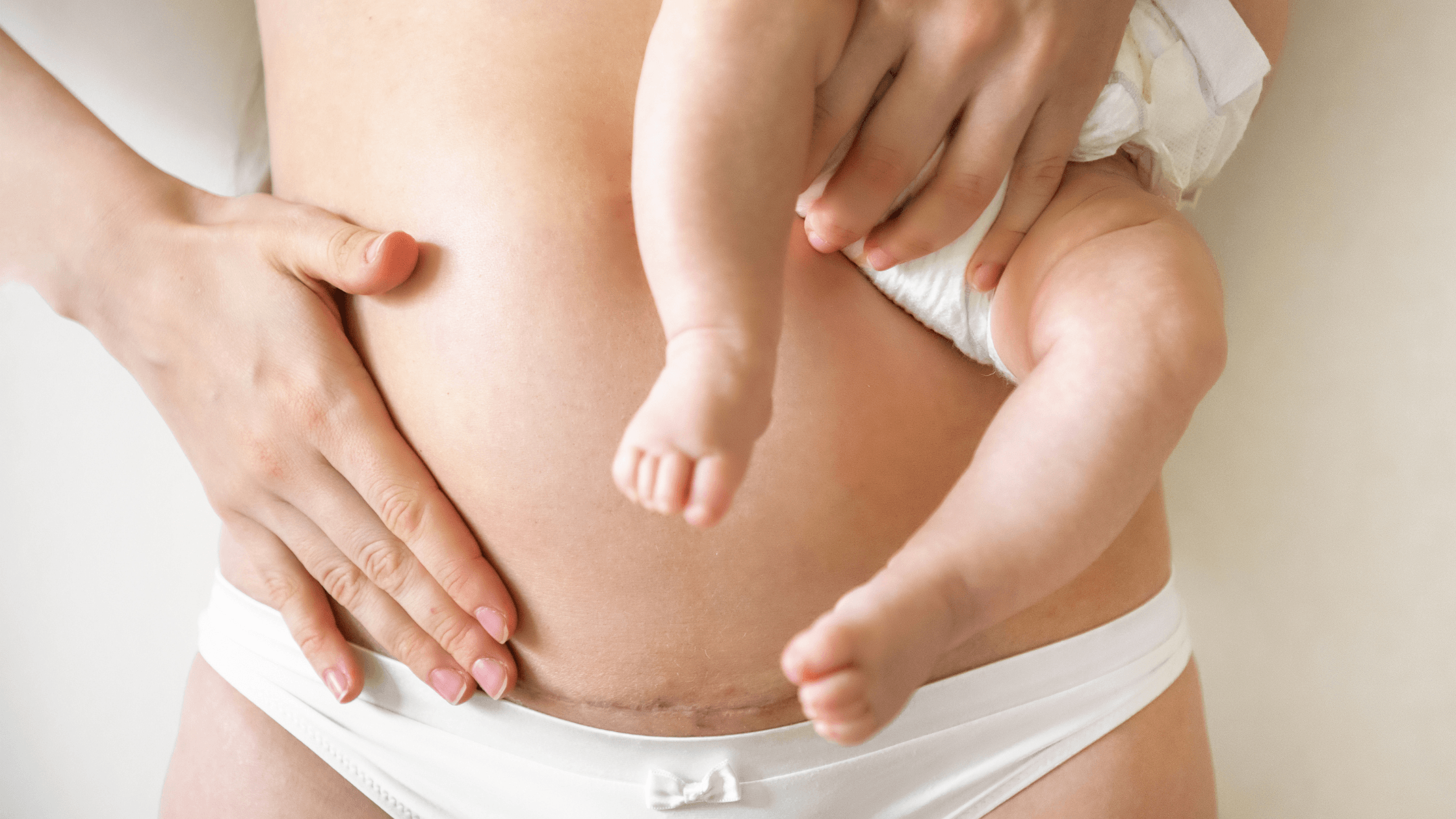 A close-up of a woman’s lower abdomen showing a healed C-section scar while she holds her baby, representing the journey of postpartum recovery and scar revision at Entice Dallas.